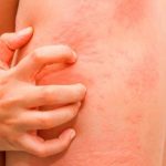 urticaria